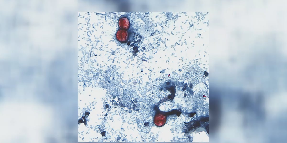Cyclosporiasis outbreak in Michigan grows to nearly 700 cases