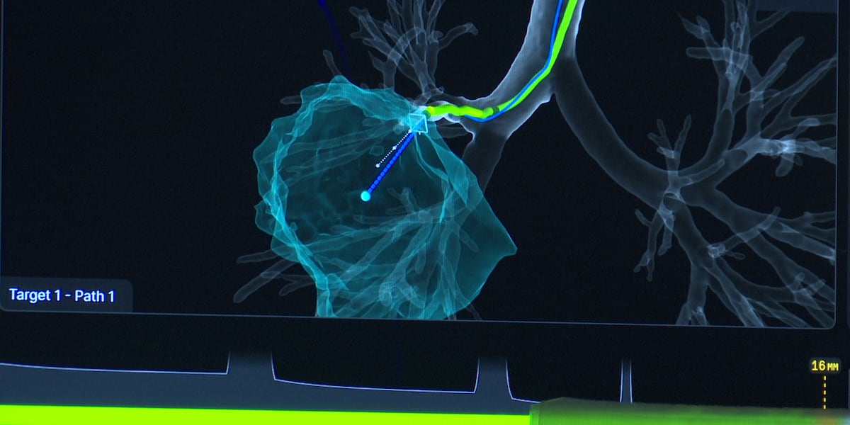 New robotic tool at University of Michigan Health-Sparrow helping detect lung cancer early
