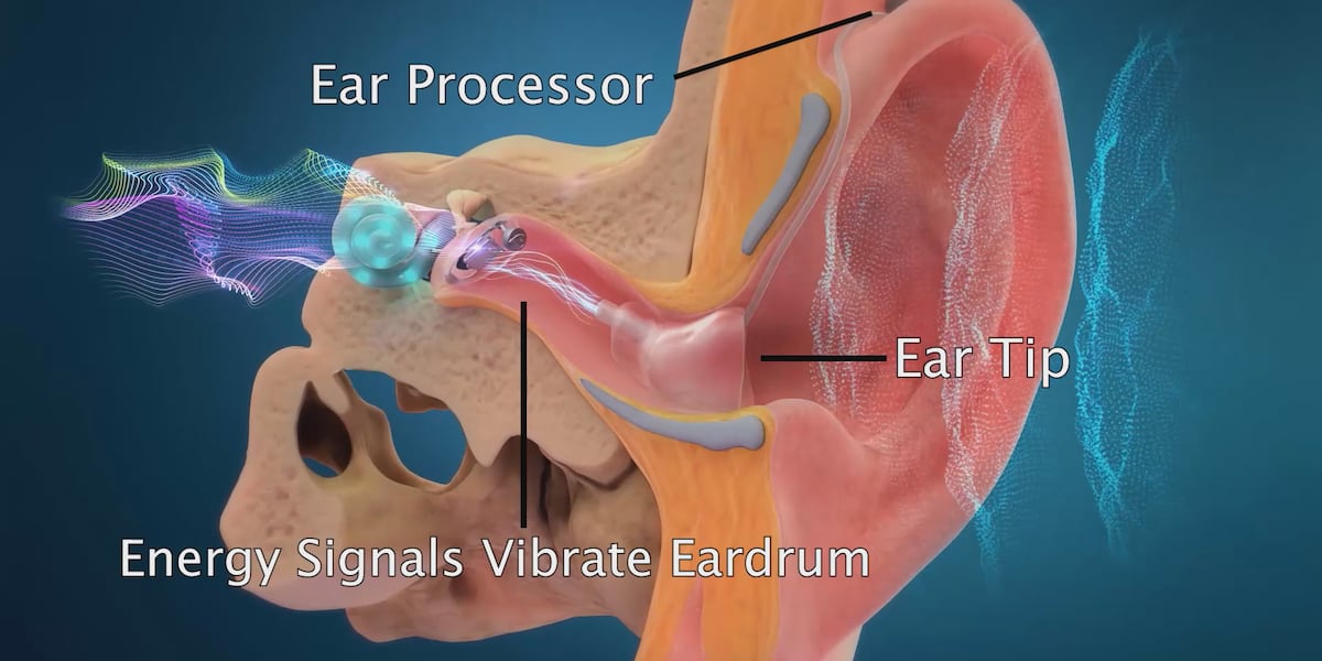 Red Earlens Can You Hear Me Now? Earlens For Your Hearing